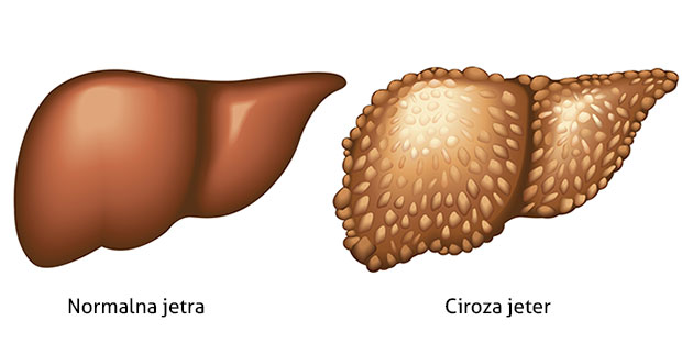 Ciroza jeter - kakšni so simptomi in kaj se dogaja v jetrih 3 Ciroza jeter