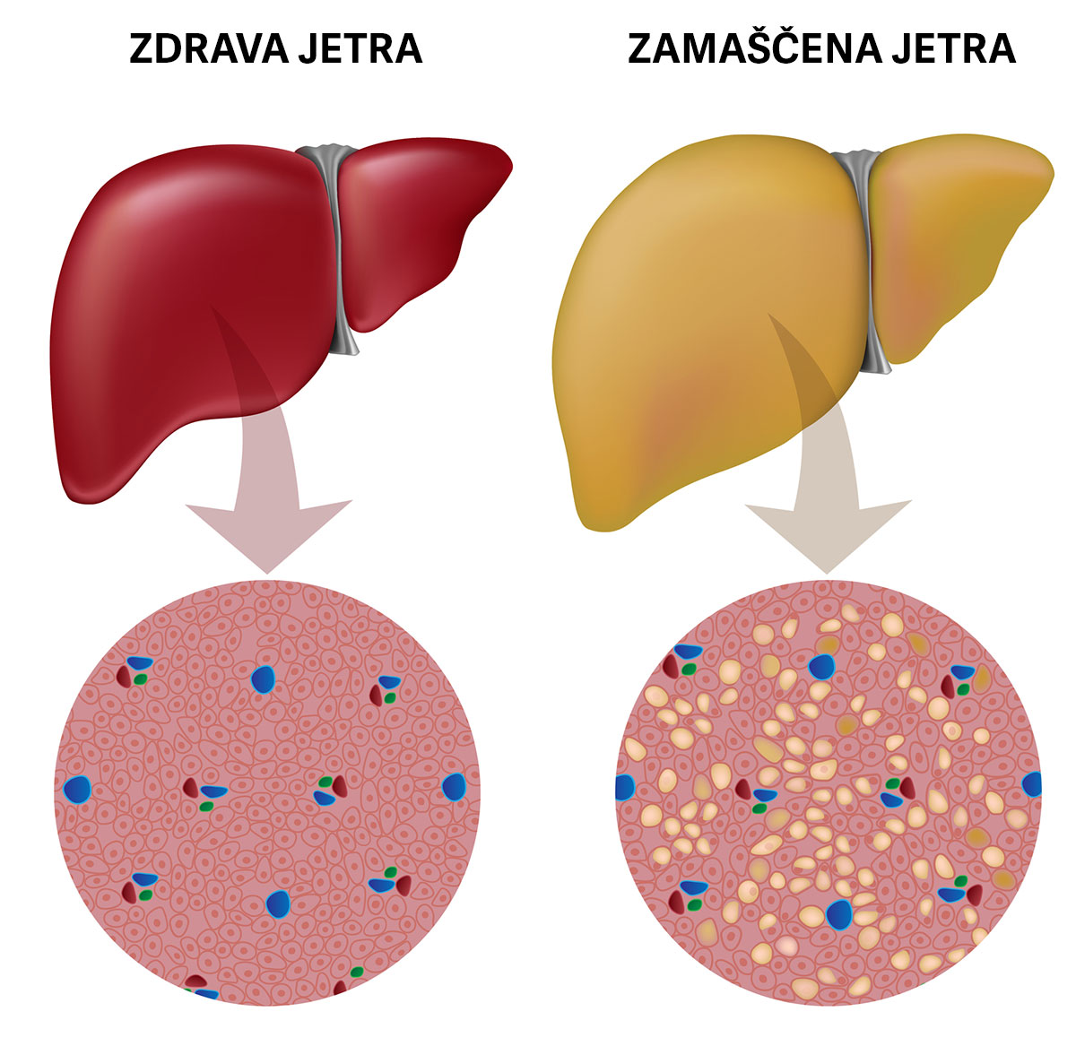Ciroza jeter - kakšni so simptomi in kaj se dogaja v jetrih 2 Ciroza in zamaščenost jeter
