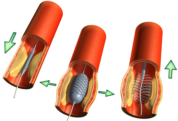 operacija aorte