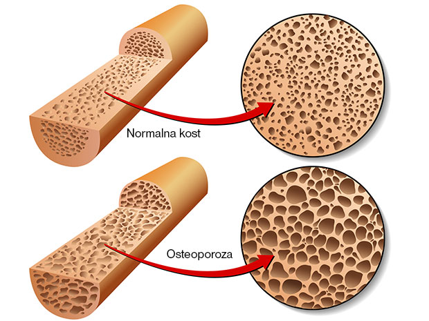 Osteoporoza