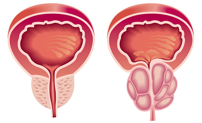 Benigna hiperplazija prostate