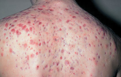 Brazgotine in strije – trajne oznake na koži 2 Atrofične brazgotine