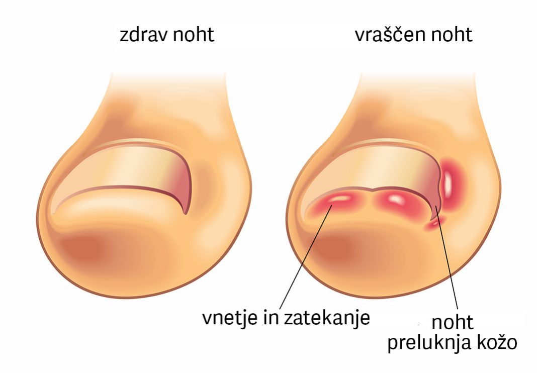 Vraščeni nohti