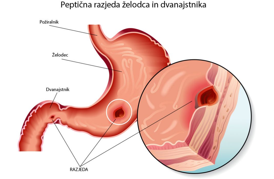 Peptična razjeda na želodcu in dvanajstniku
