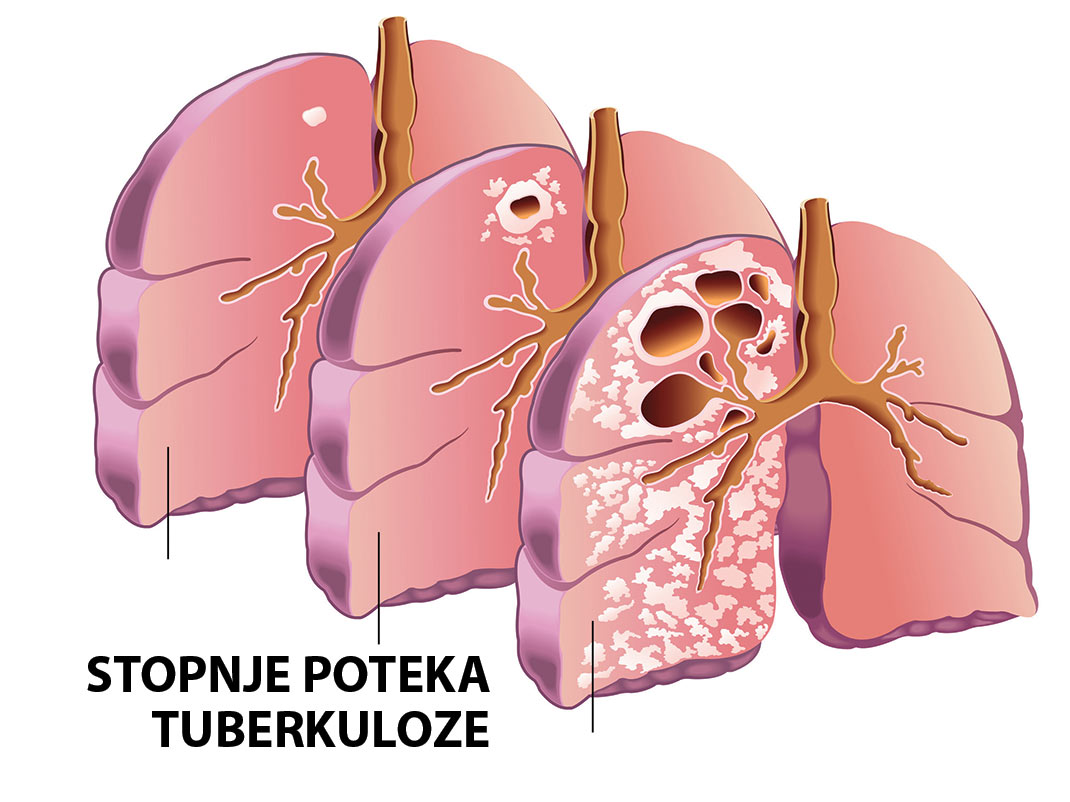 Tuberkuloza