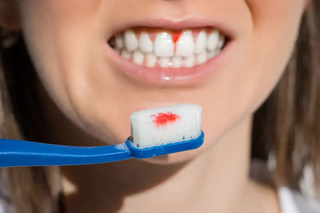 Parodontalna bolezen in krvavenje dlesni