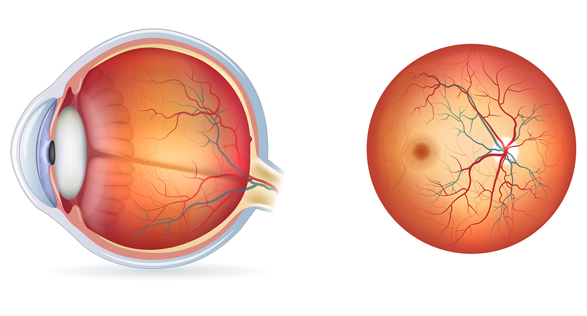 Diabetična retinopatija