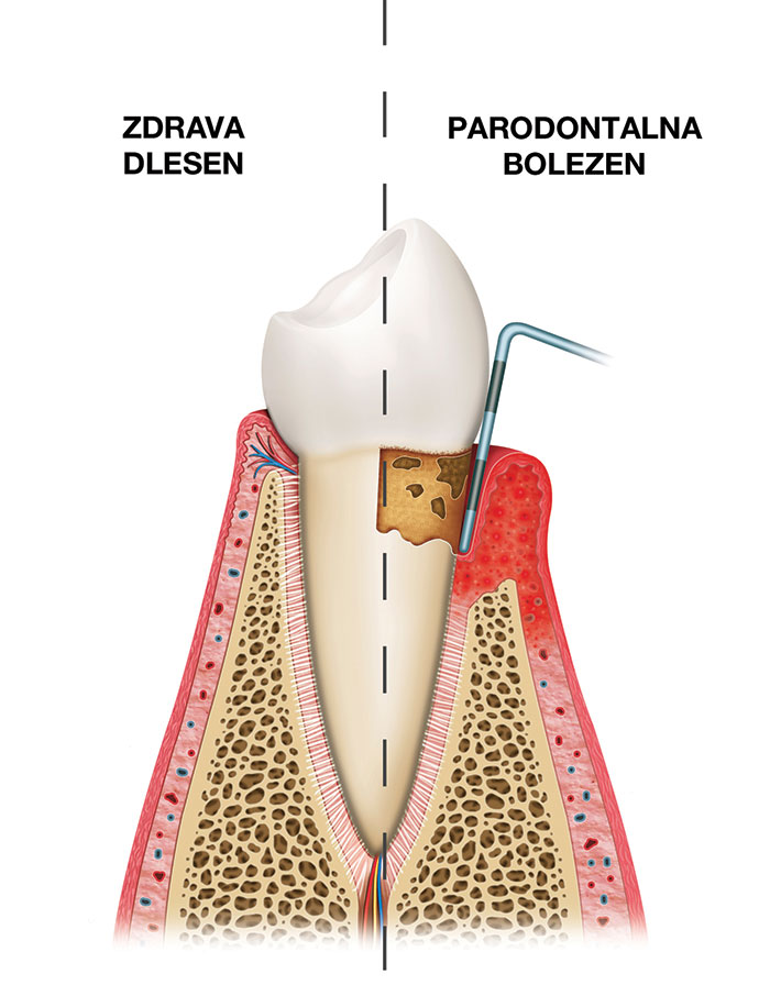 Parodontalna bolezen