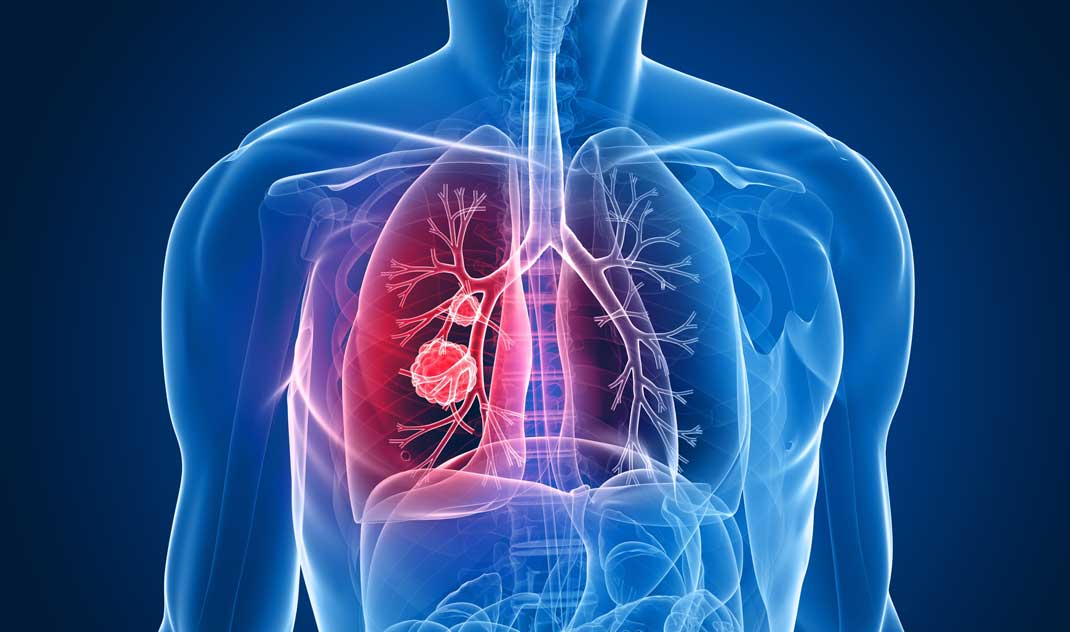 Zdravljenje pljučnega raka