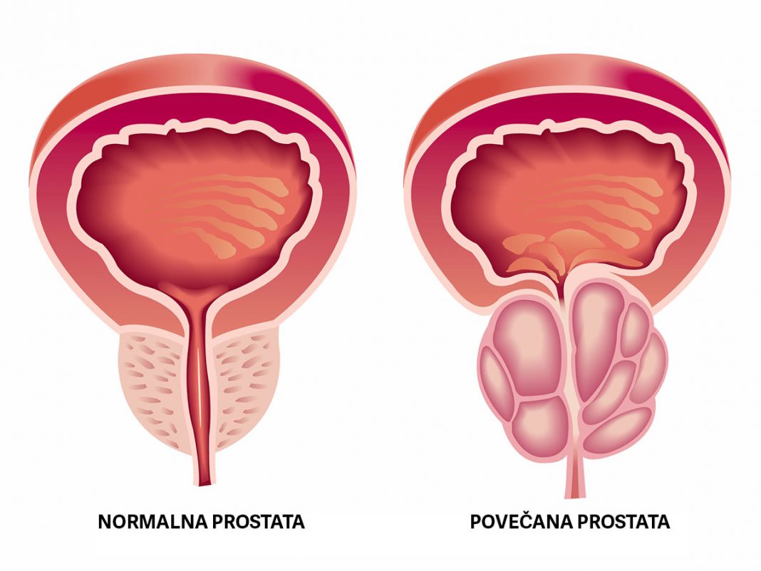 rak prostate, povečana prostata