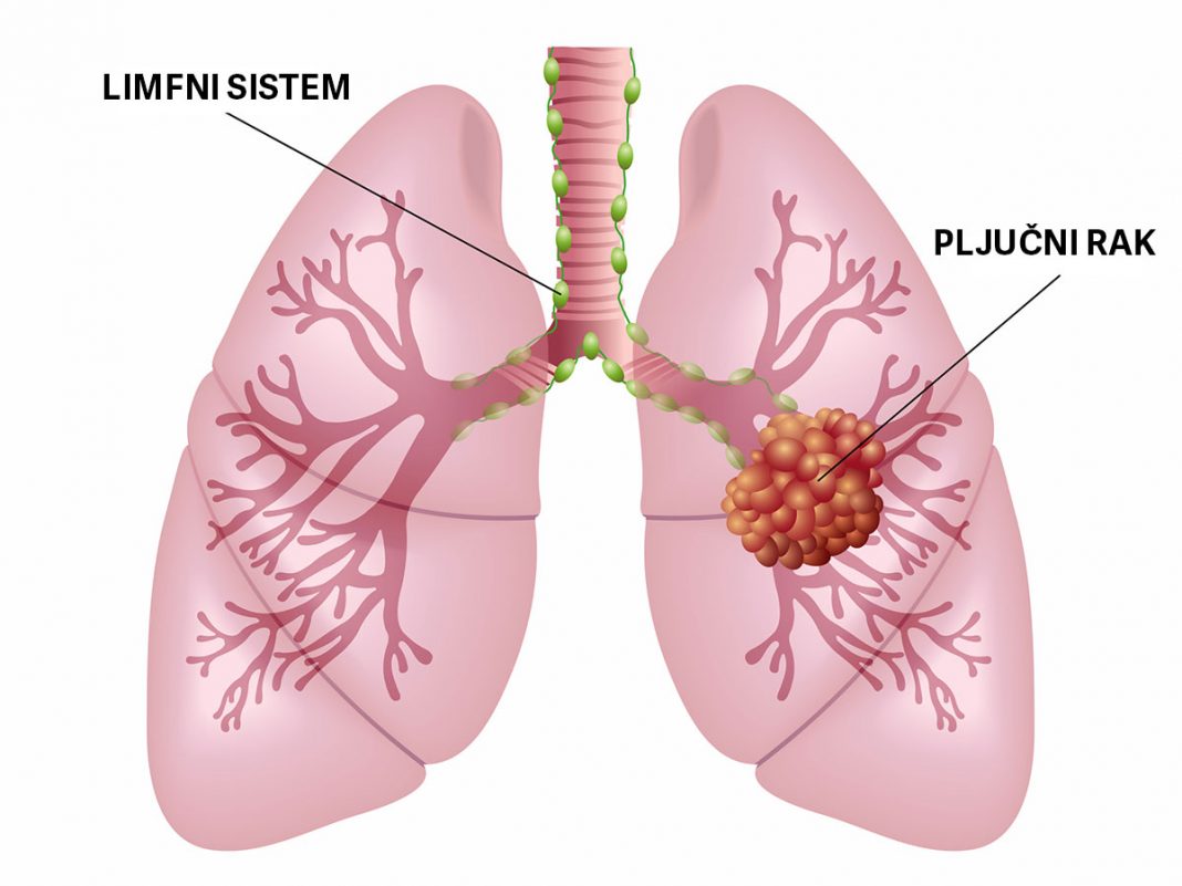 Pljučni rak