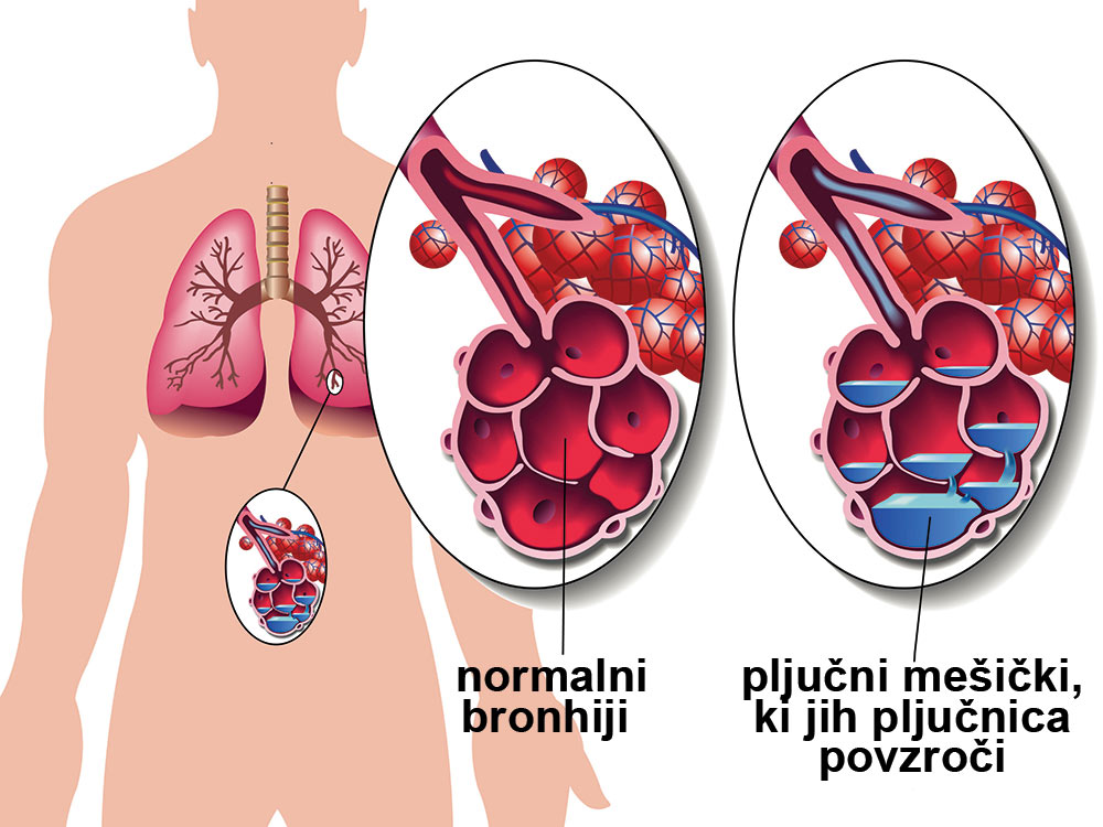 Atipična pljučnica simptomi in posledice