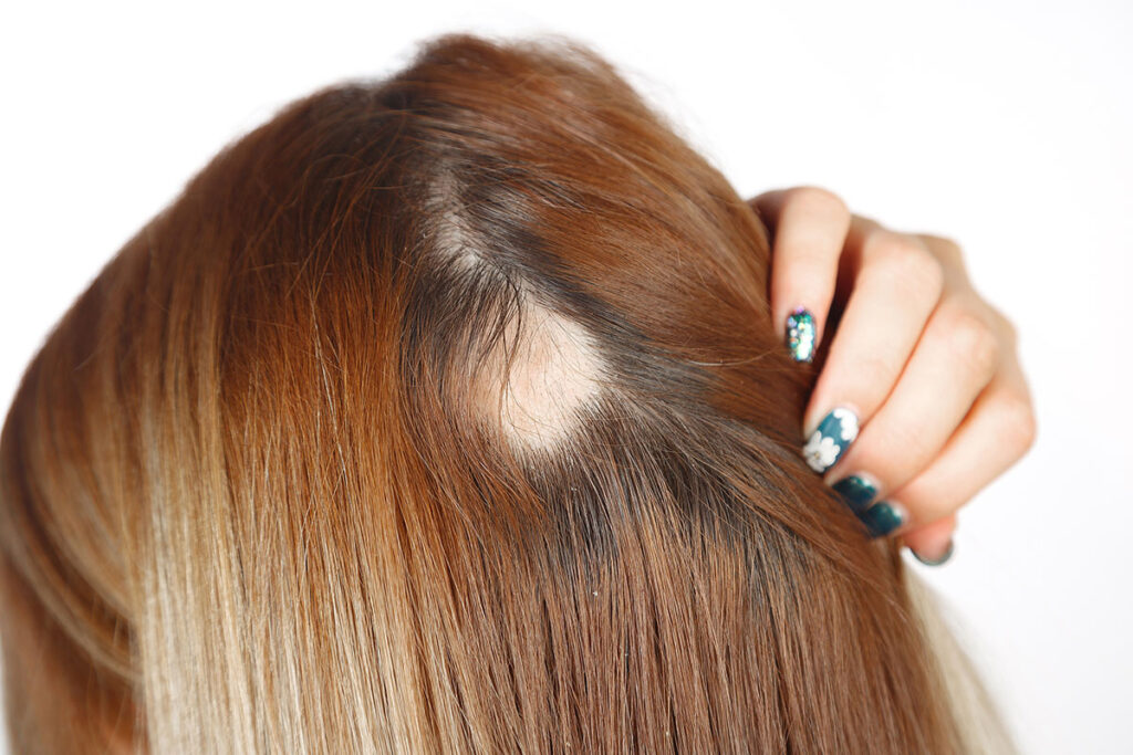 Izpadanje las zaradi stresa Telogen effluvium