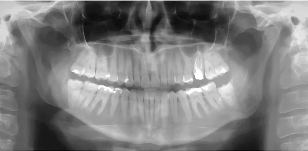 Ortopanski posnetek urejenega zobovja.