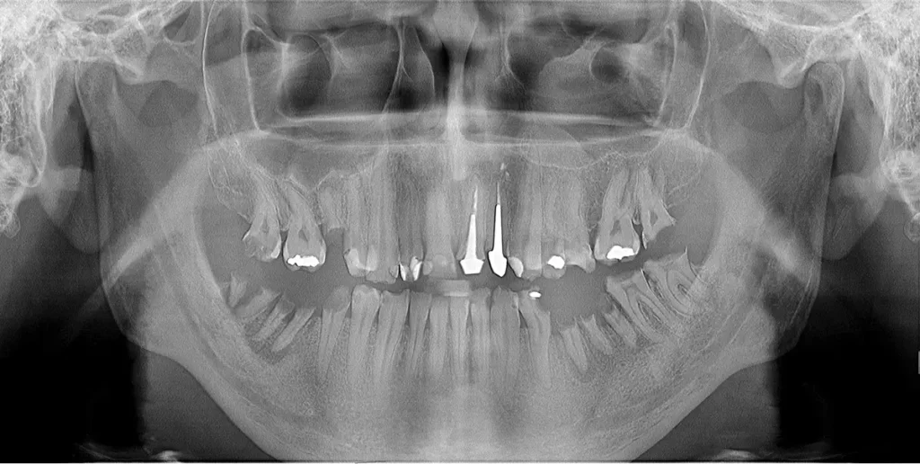 Ortopanski posnetek neurejenega zobovja