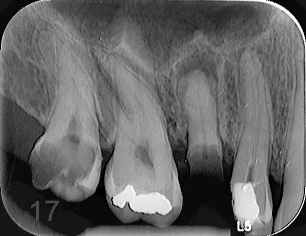 Zobni rentgen slika 3