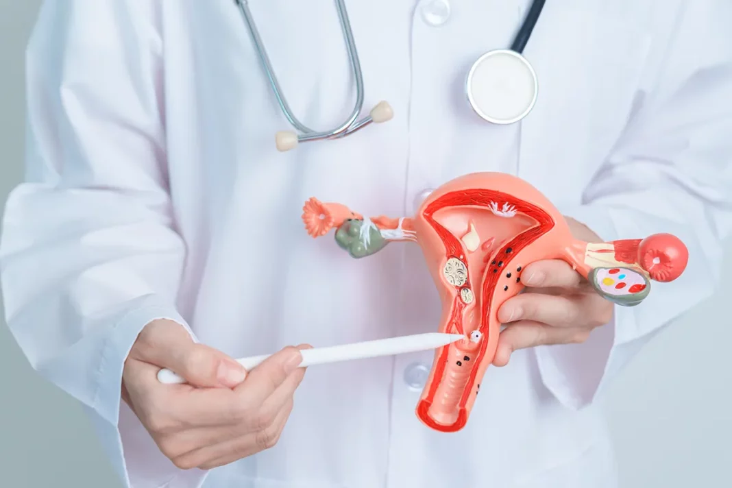 Endometrioza