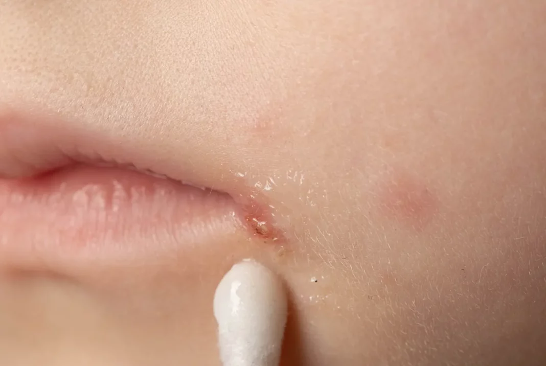 Impetigo