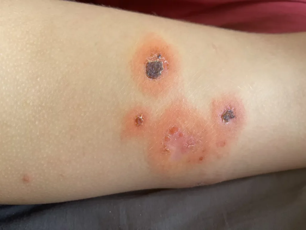Impetigo simptomi