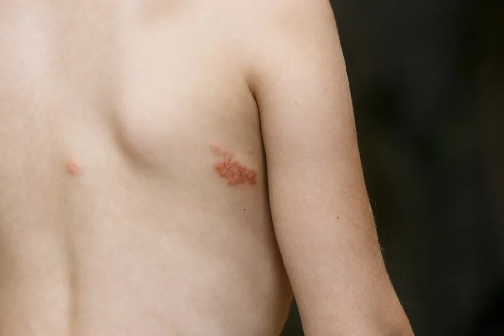 Impetigo simptomi znaki