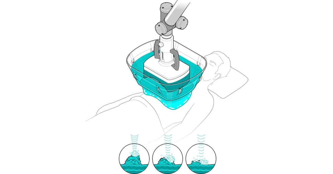 ilustracija naprave histosonics čez trebuh pacienta pošiljanje ultrazvoka skozi membrano napolnjeno z vodo v telo